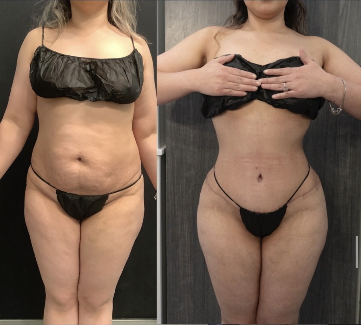 Before and after abdominal liposuction, front view, by Dr. Ronald Espinoza
