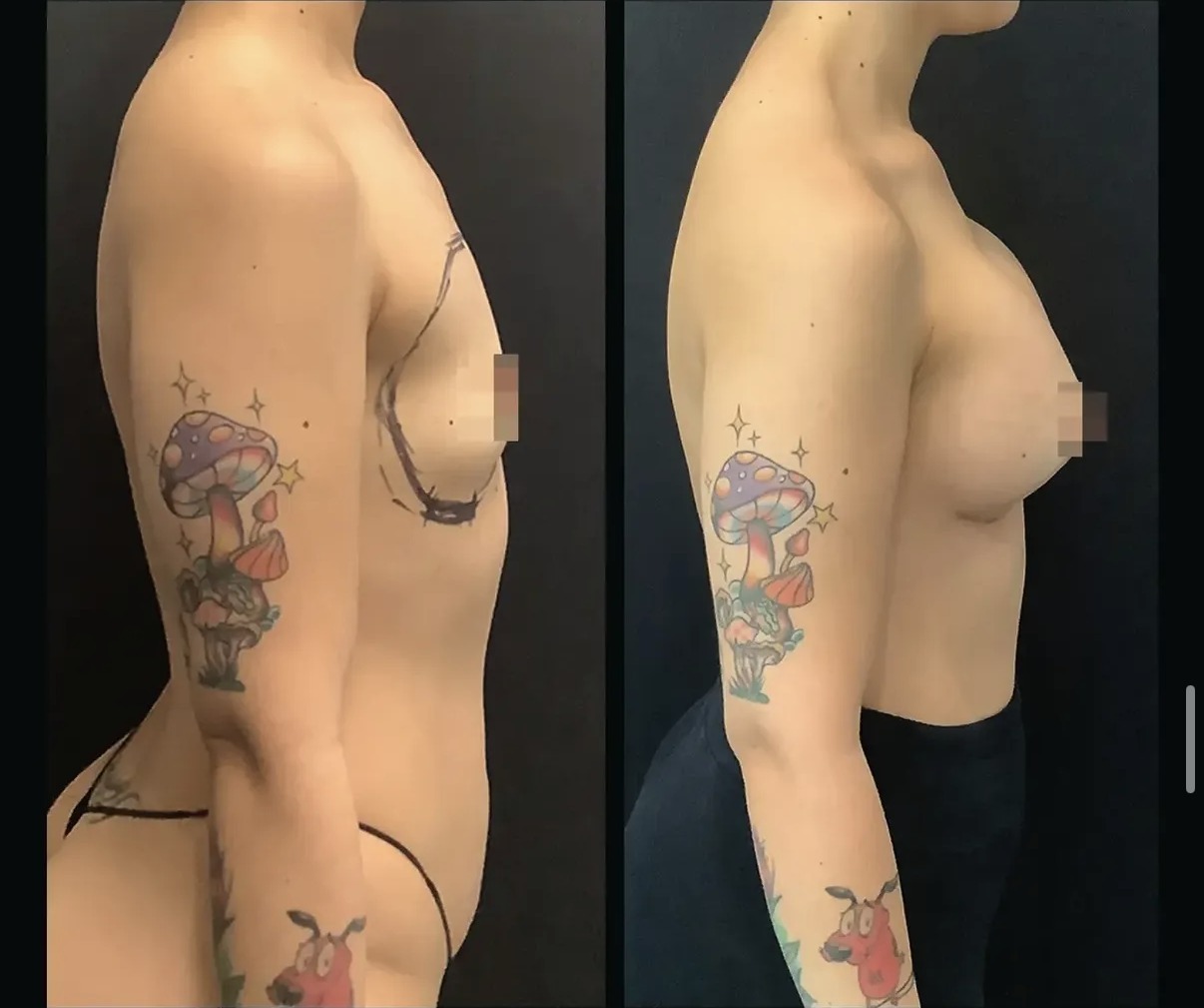 Before and after breast lift, side profile, by Dr. Ronald Espinoza