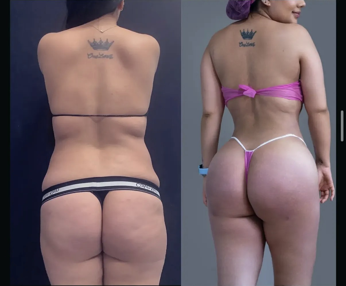Before and after BBL and back liposuction by Dr. Ronald Espinoza
