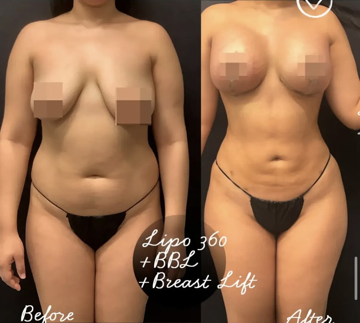 Before and after Lipo 360 with BBL and breast lift by Dr. Ronald Espinoza