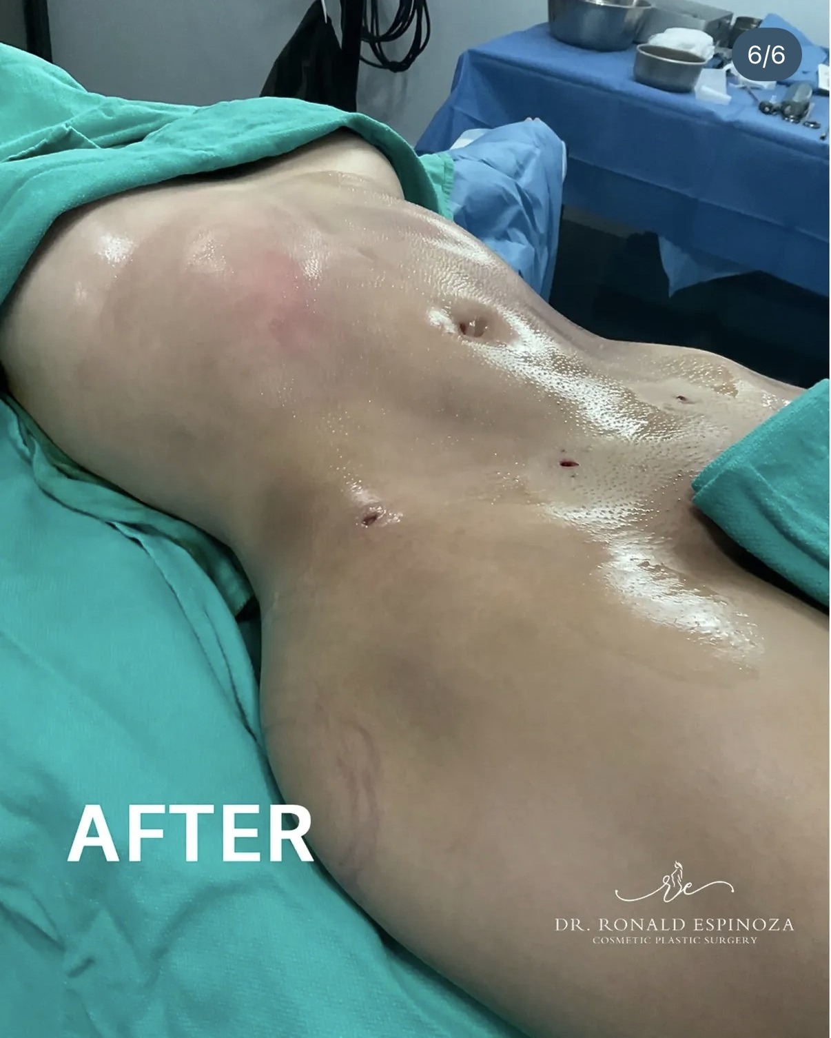 After abdominal liposuction showing flat contour by Dr. Ronald Espinoza