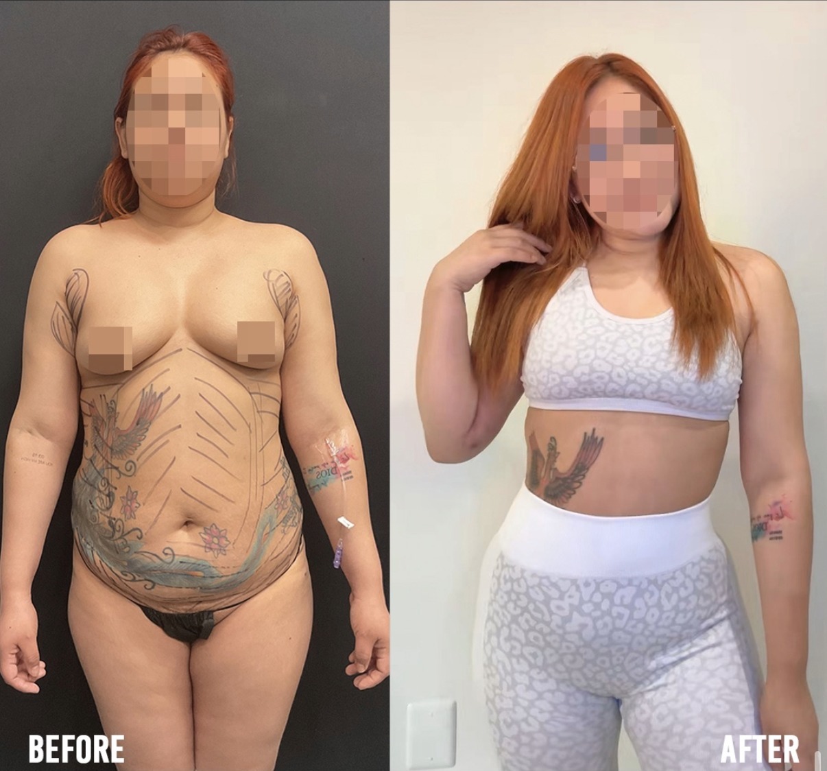 Before and after tummy tuck and abdominal contouring by Dr. Ronald Espinoza