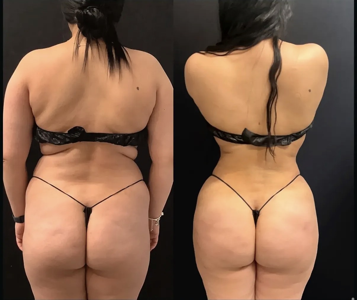 Before and after Brazilian butt lift, back view, by Dr. Ronald Espinoza
