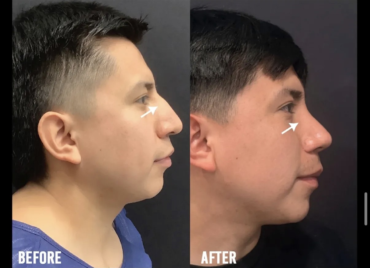 Before and after rhinoplasty profile view by Dr. Ronald Espinoza