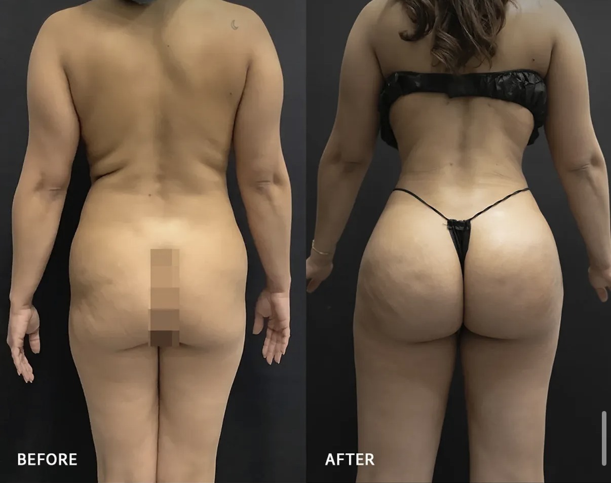 Before and after Brazilian butt lift and body contouring by Dr. Ronald Espinoza