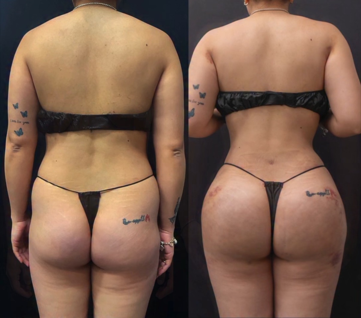 Before and after back liposuction and Brazilian butt lift by Dr. Ronald Espinoza