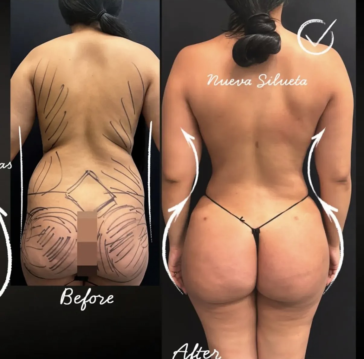 Before and after Lipo 360 back view with sculpted silhouette by Dr. Ronald Espinoza