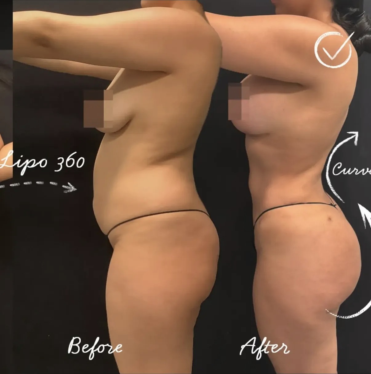 Before and after Lipo 360 side profile showing a defined waist by Dr. Ronald Espinoza