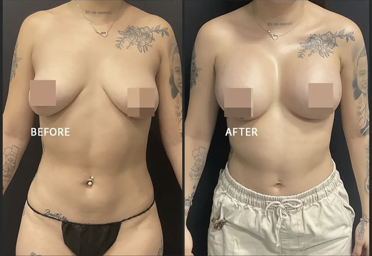 Before and after breast augmentation with tattooed torso by Dr. Ronald Espinoza