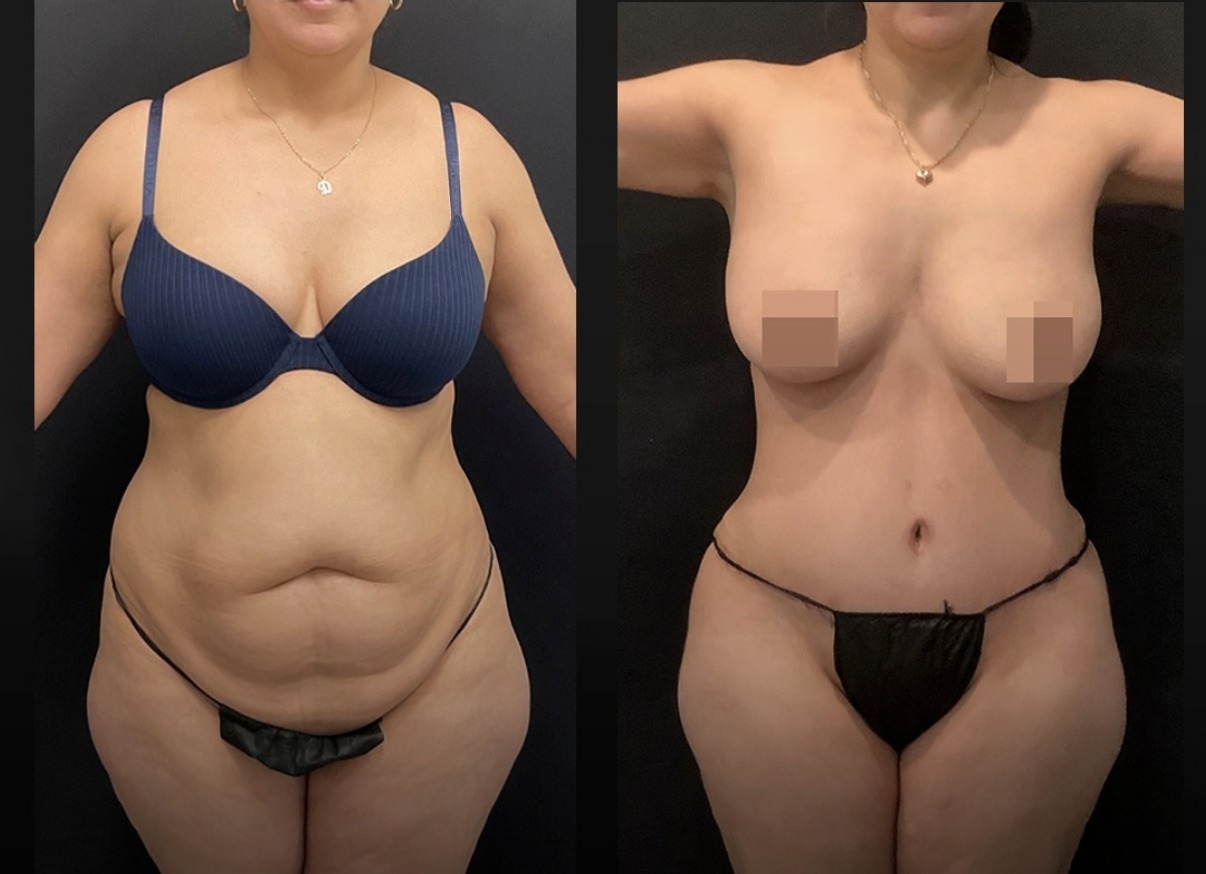 Before and after tummy tuck with breast augmentation by Dr. Ronald Espinoza
