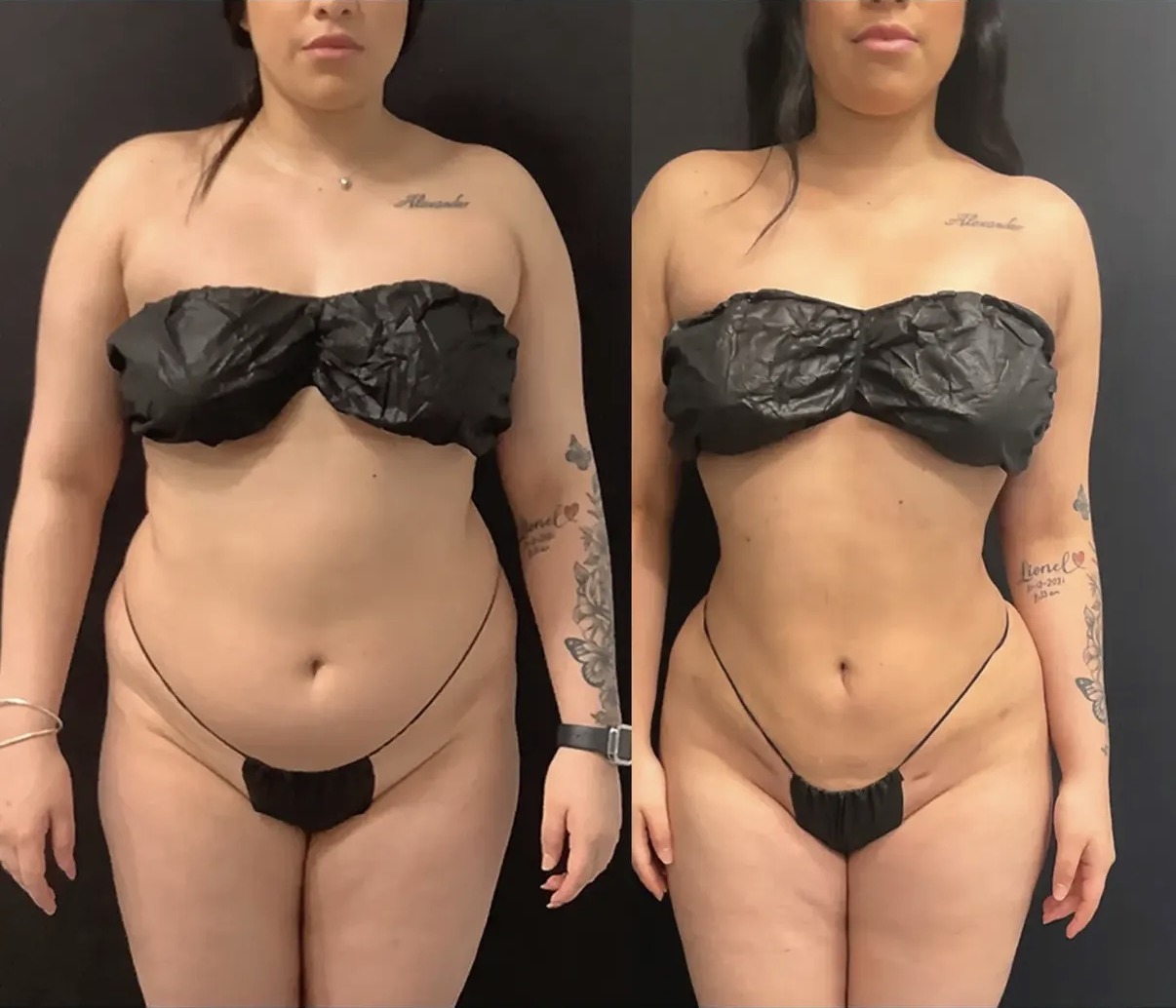 Before and after Lipo 360 front view with contoured waistline by Dr. Ronald Espinoza