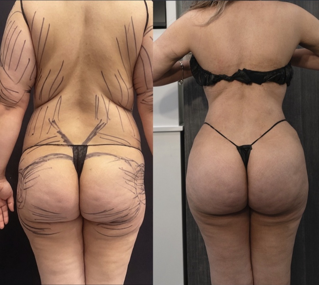 Before and after BBL with lipo markings, back view, by Dr. Ronald Espinoza