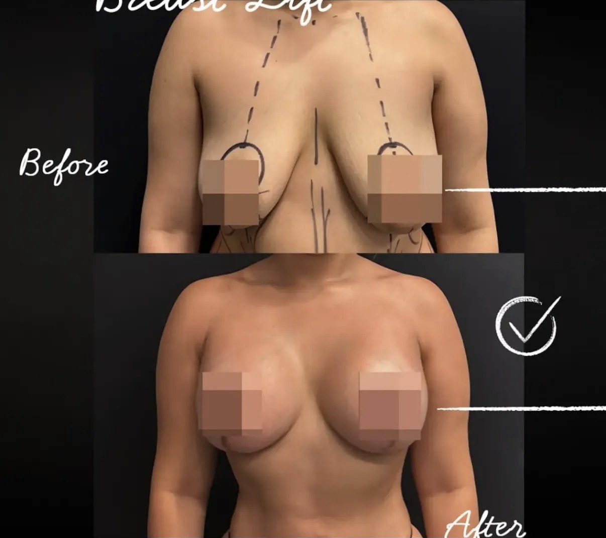 Before and after breast lift with surgical markings by Dr. Ronald Espinoza